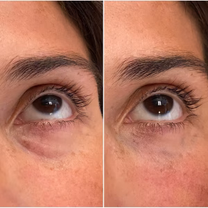 Polinucleótidos PLENHYAGE®️ XL Thin Periocular - Peribucal