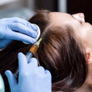 PRP + Mesoterapia Capilar